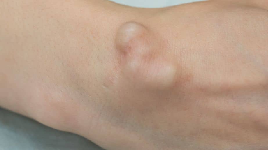 Persistent Lumps or Swelling